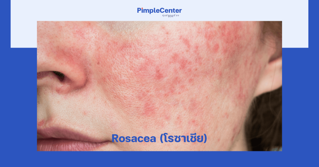 อาการ acne rosacea ผื่นแดงบนหน้า
